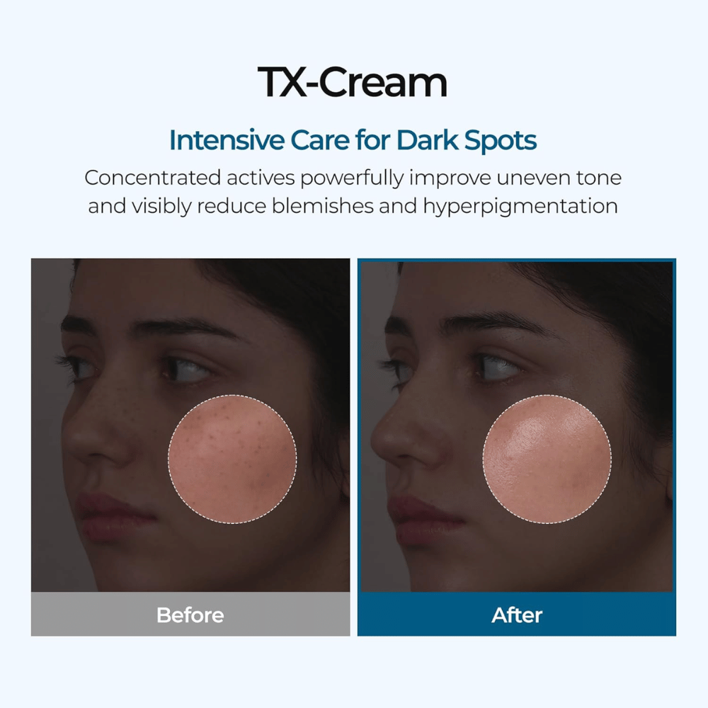 Före och efter resultat med TX Cream som reducerar mörka fläckar och ojämn hudton för en synligt klarare och jämnare hud