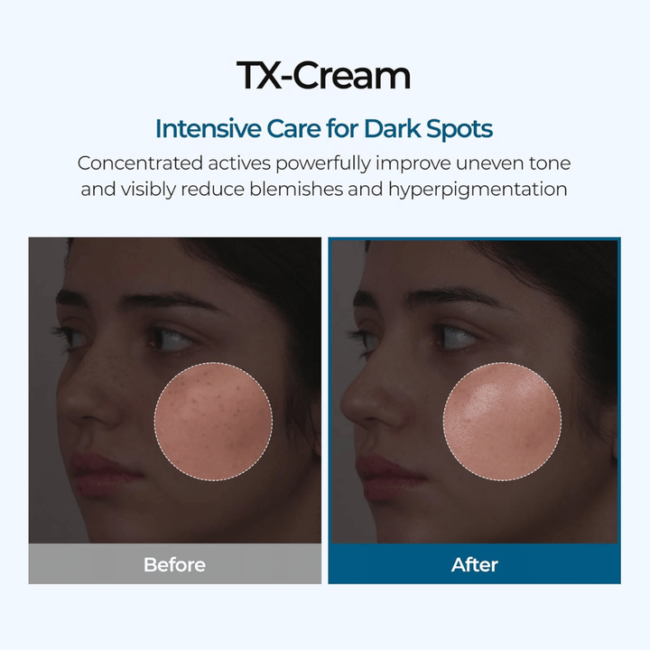 Före och efter resultat med TX Cream som reducerar mörka fläckar och ojämn hudton för en synligt klarare och jämnare hud